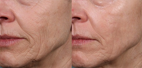 Clinical Results